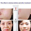Acne Treatment Face Cream Anti Acne Oil Control Shrink Moisturizer Cream Pores Pimple Care Removal Skin Stretch Whitening M H5F4
