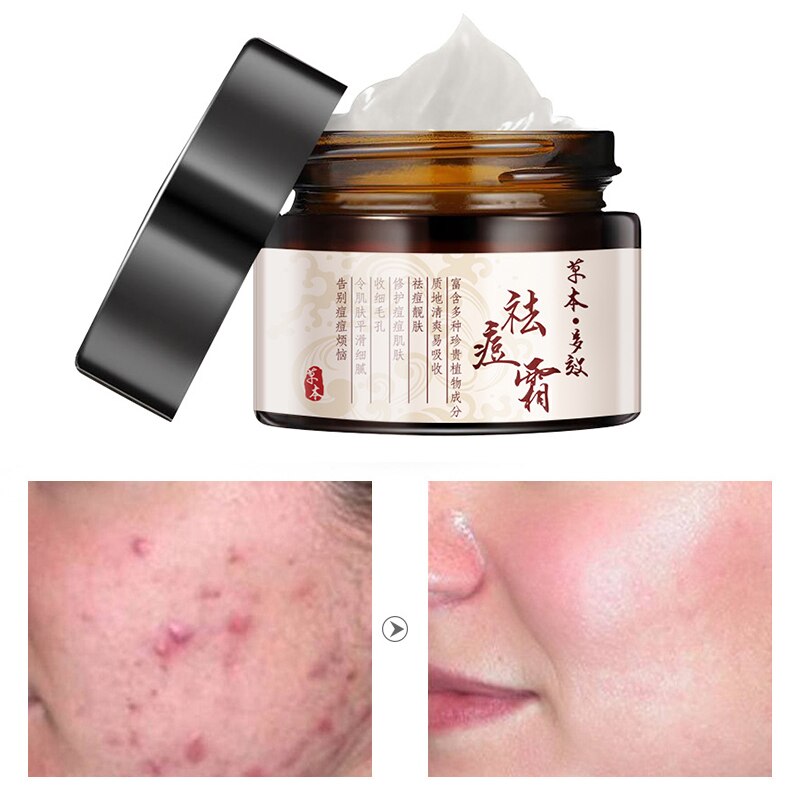 Herbal Acne Cream Anti Pimple Spot Acne Scars Blackhead Removal Cream Whitening Beauty Skin Face Care Creams Acne Treament TSLM1