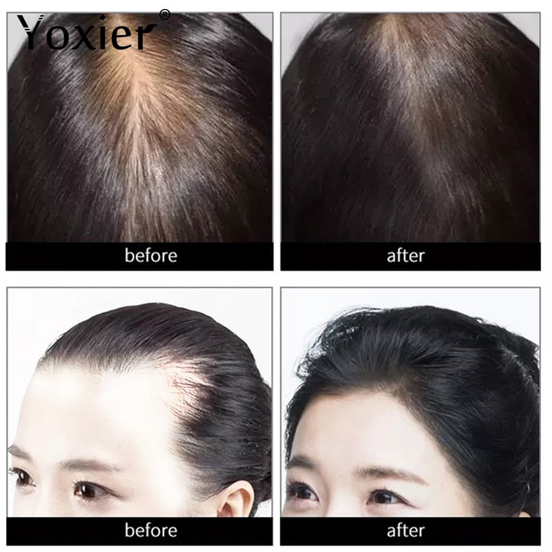 Yoxier 3Pcs Hair Growth Essence Oil Effective Extract Anti Nourish Hair Roots Treatment Preventing Hair Loss Hair Care Products