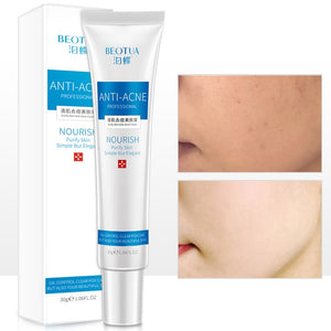 30g Acne Treatment Blackhead Removal Anti Acne Cream Oil Control Shrink Pores Acne Scar Remove Face Care Whitening TSLM1
