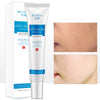 Herbal Acne Cream Anti Pimple Spot Acne Scars Blackhead Removal Cream Whitening Beauty Skin Face Care Creams Acne Treament TSLM1