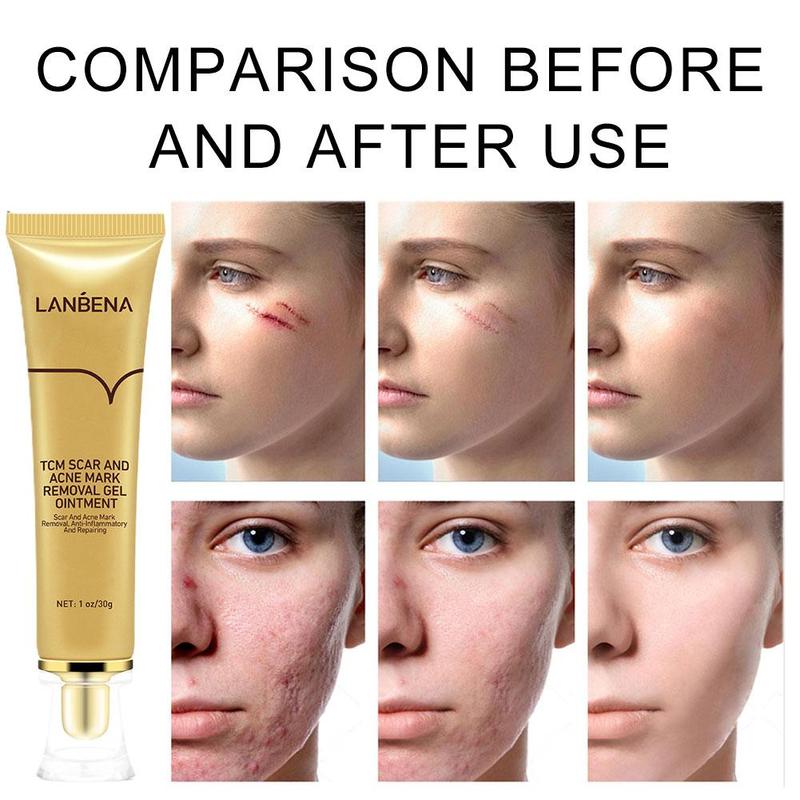 LANBENA Acne Scar Removal Cream Cosmetics For Face Screm TCM Herbal Repair Stretch Marks Remove Scar Treatment Bioaqua Skin Care