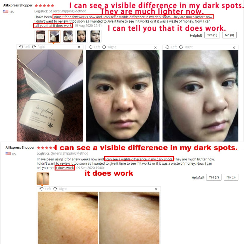 OMY LADY Freckle Removal Cream Remove Freckle Pregnant Spots Melanin Dark Spot Anti Aging Whitening Facial Cream Brightening