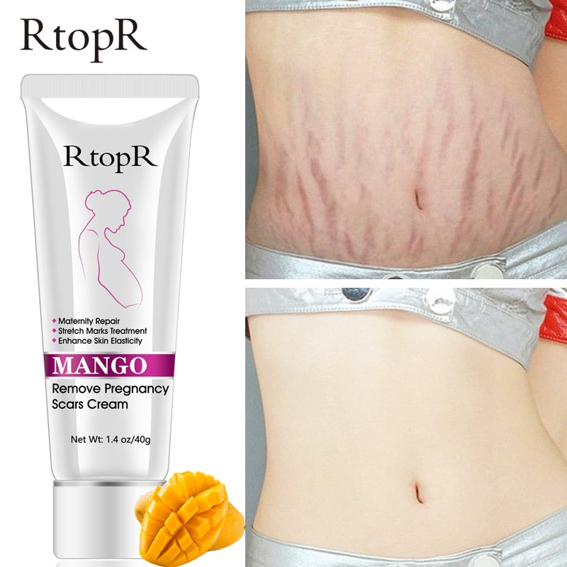 Mango Remove Pregnancy Scars Acne Cream Stretch Marks Treatment Maternity Repair Anti-Aging Anti Winkles Firming Body Creams