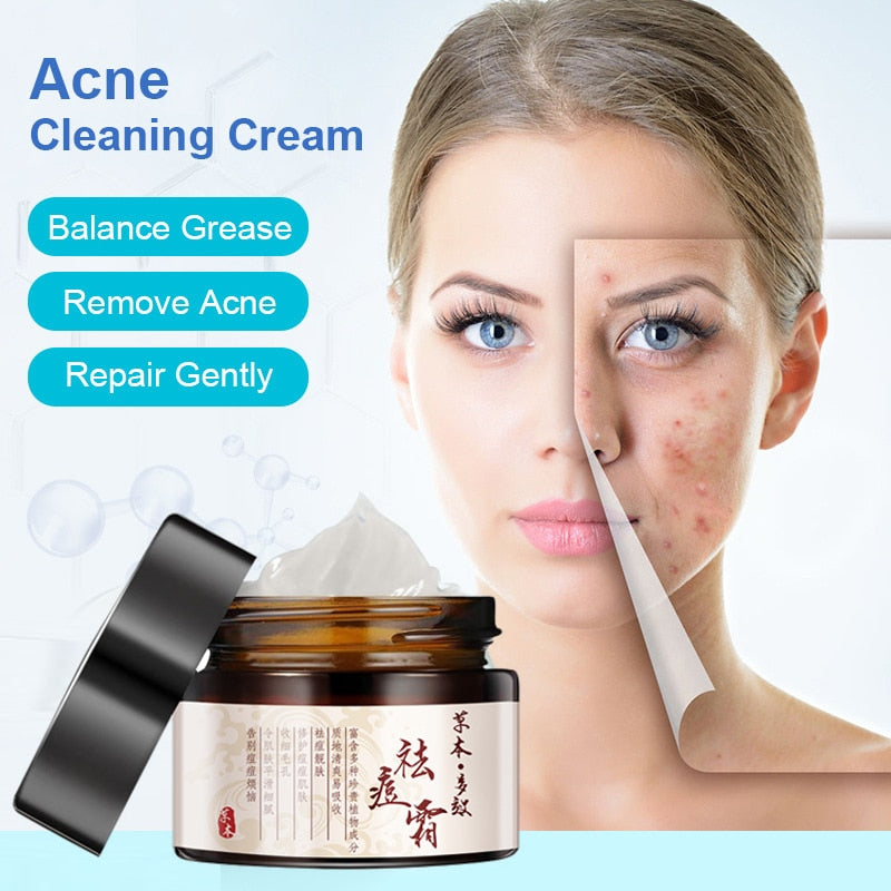 Herbal Acne Cream Anti Pimple Spot Acne Scars Blackhead Removal Cream Whitening Beauty Skin Face Care Creams Acne Treament TSLM1